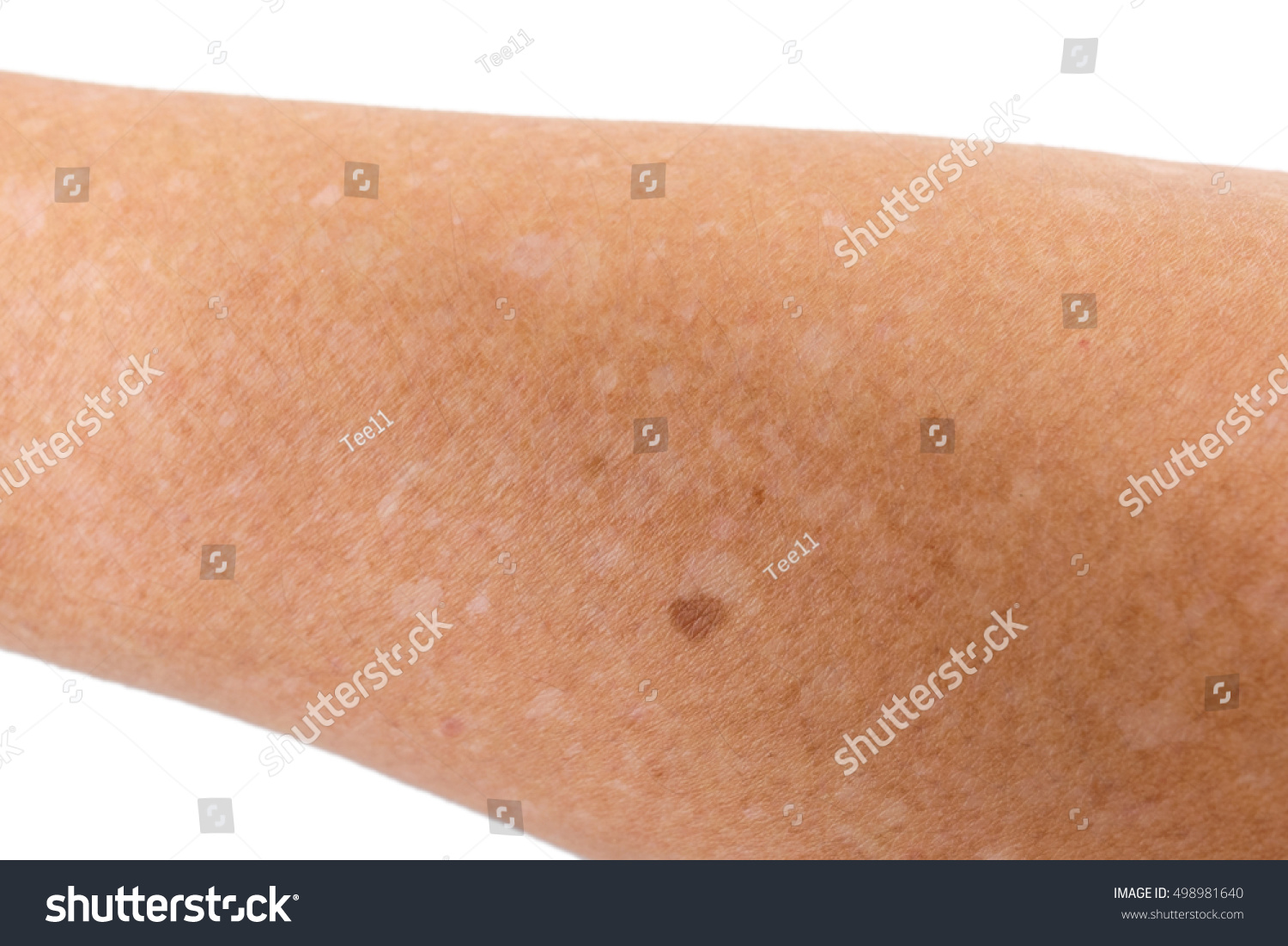 Small White Spots On Arms Idiopathic Stock Photo 498981640 Shutterstock