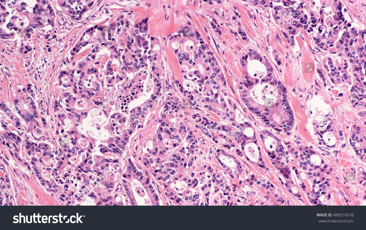 Colon Cancer Photomicrograph Microscopic Image Invasive Stock Photo ...