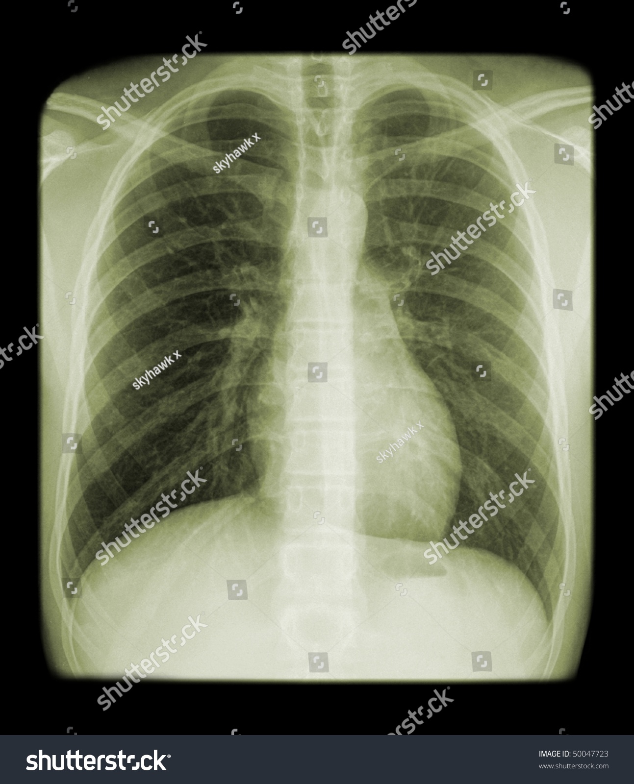 Xray Thorax Stock Photo 50047723 | Shutterstock