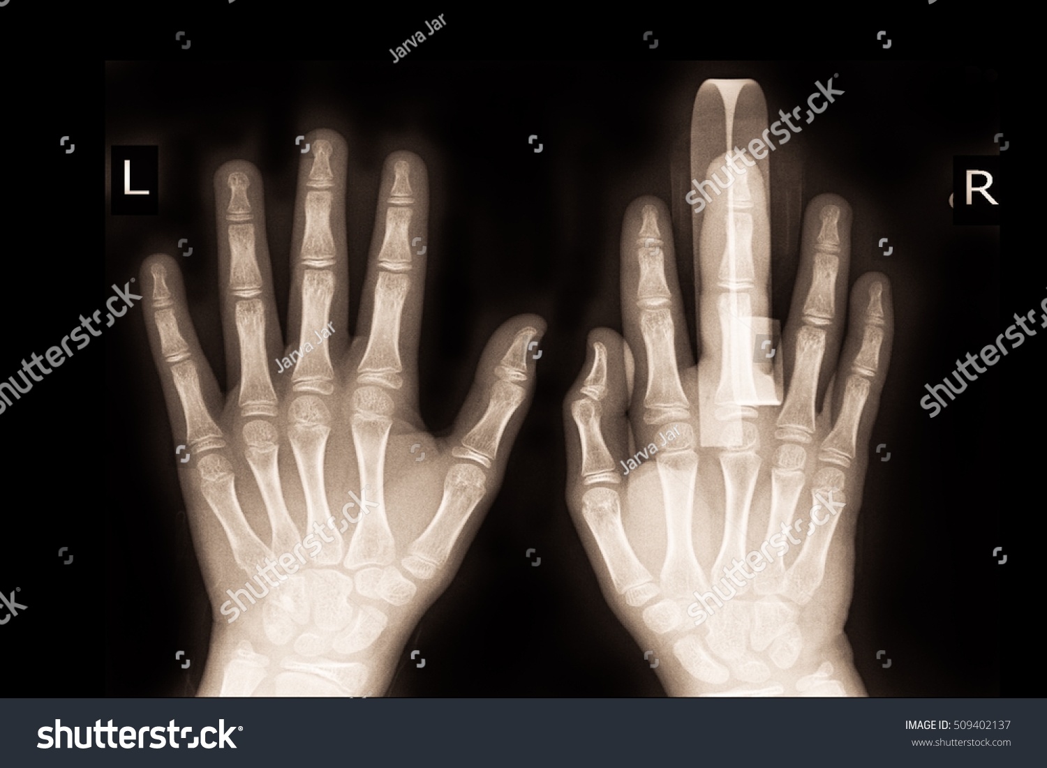 Film Xray Show Broken Middle Finger Stock Photo 509402137 | Shutterstock