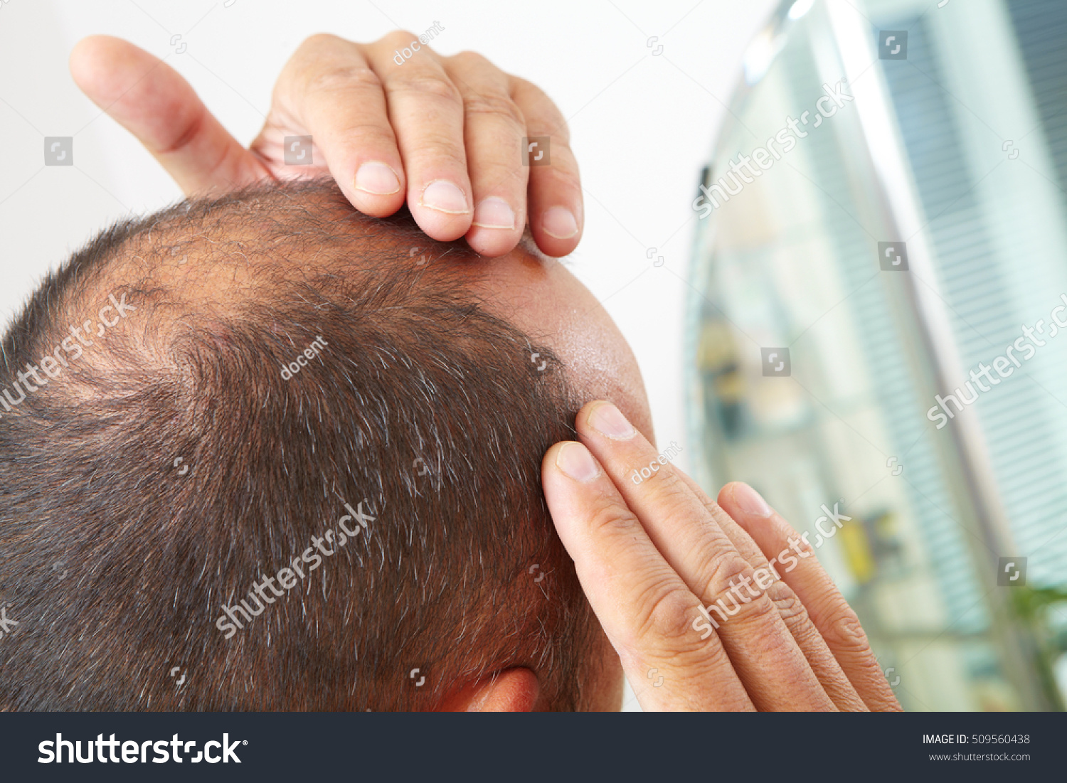 Middleaged Man Concerned Hair Loss Baldness Stock Photo 509560438 ...