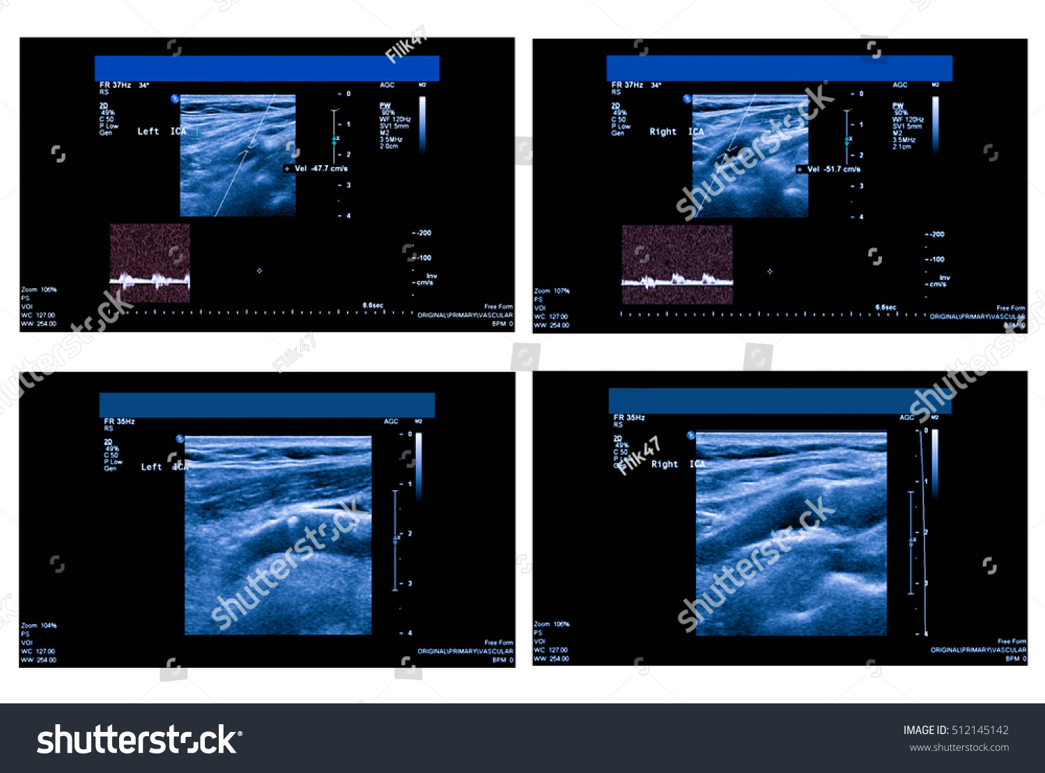 Arteria Carotis Externa Sexiezpix Web Porn