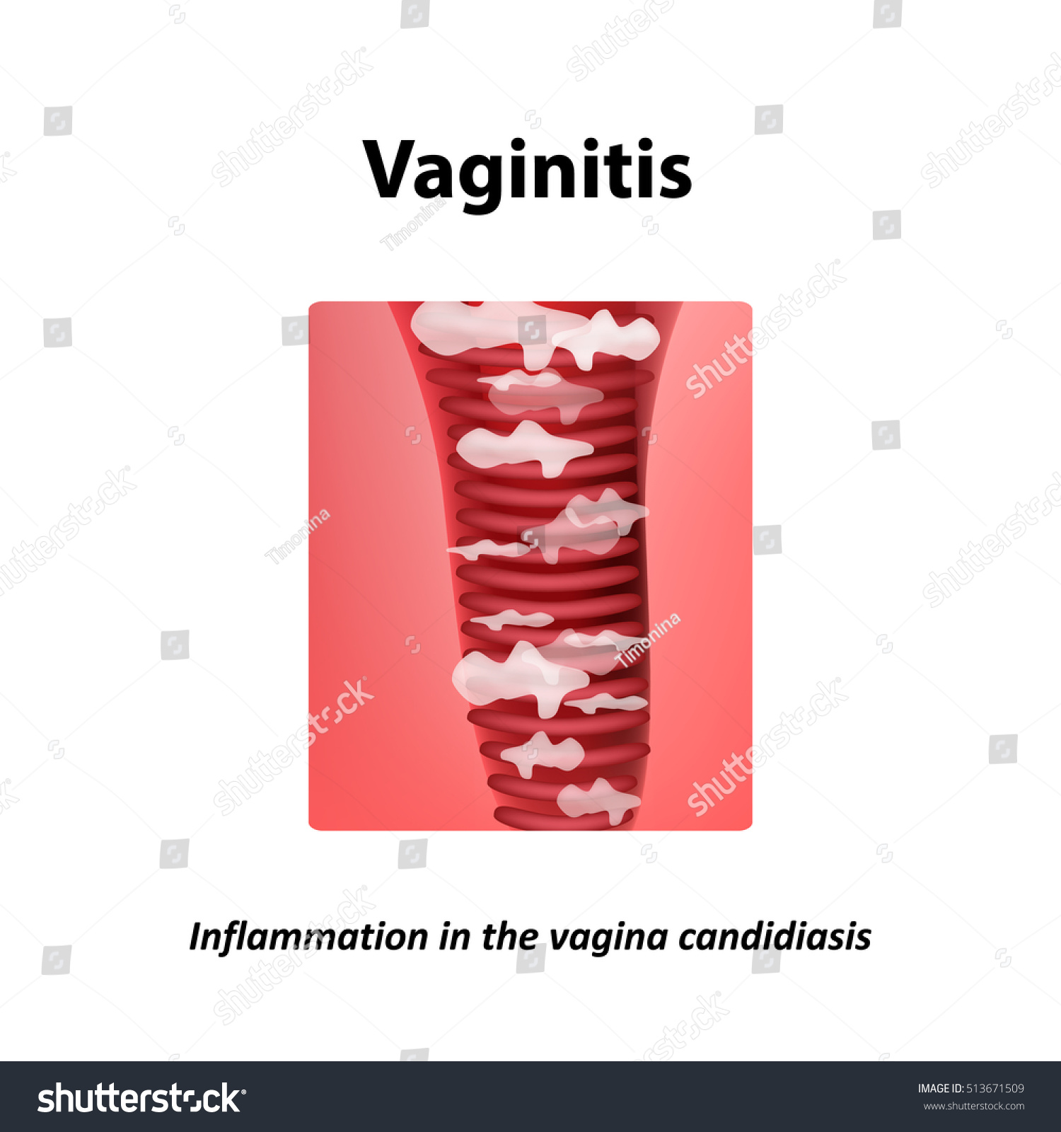 Vaginitis Inflammation Vagina Candidiasis Thrush Infographics Ilustración De Stock 513671509 