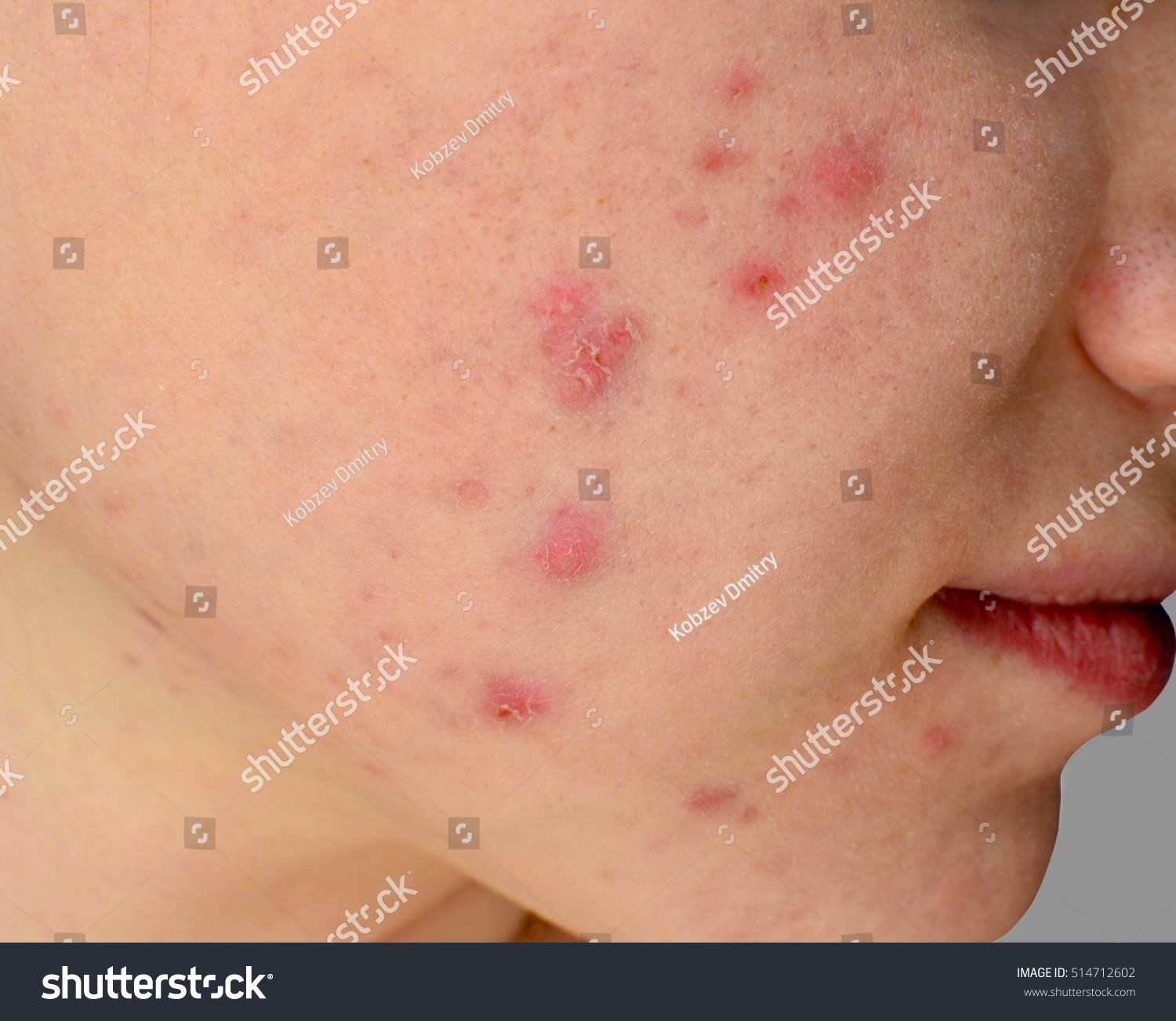 Acne Skin Because Disorders Sebaceous Glands Stock Photo 514712602