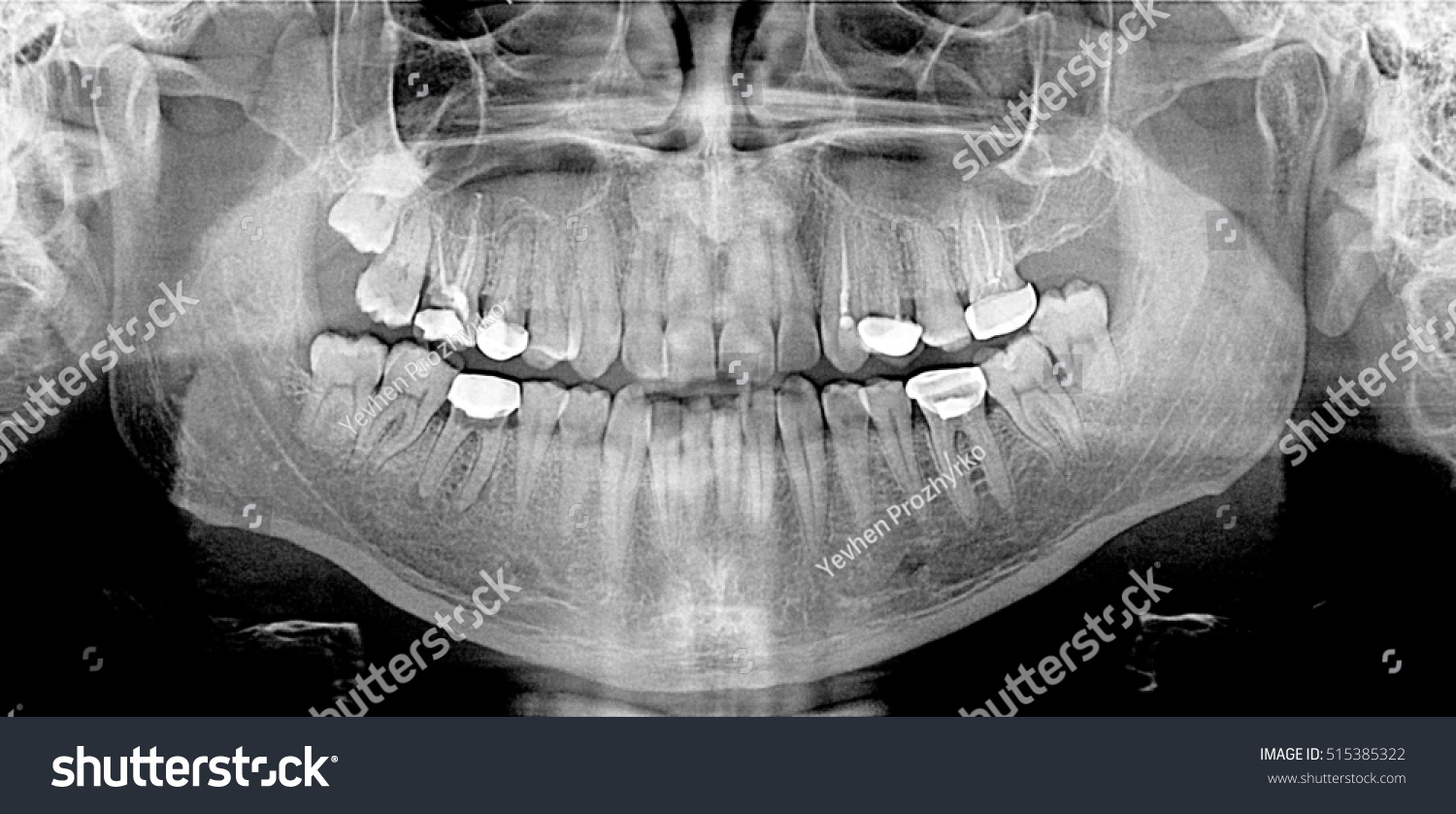 Рентгеновский снимок полости рта