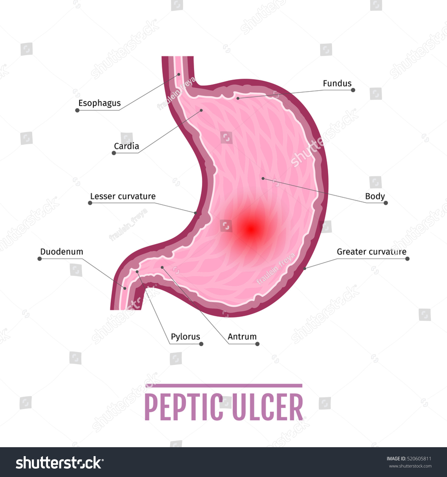 Medical Illustration Human Stomach Peptic Ulcer Stock Illustration ...