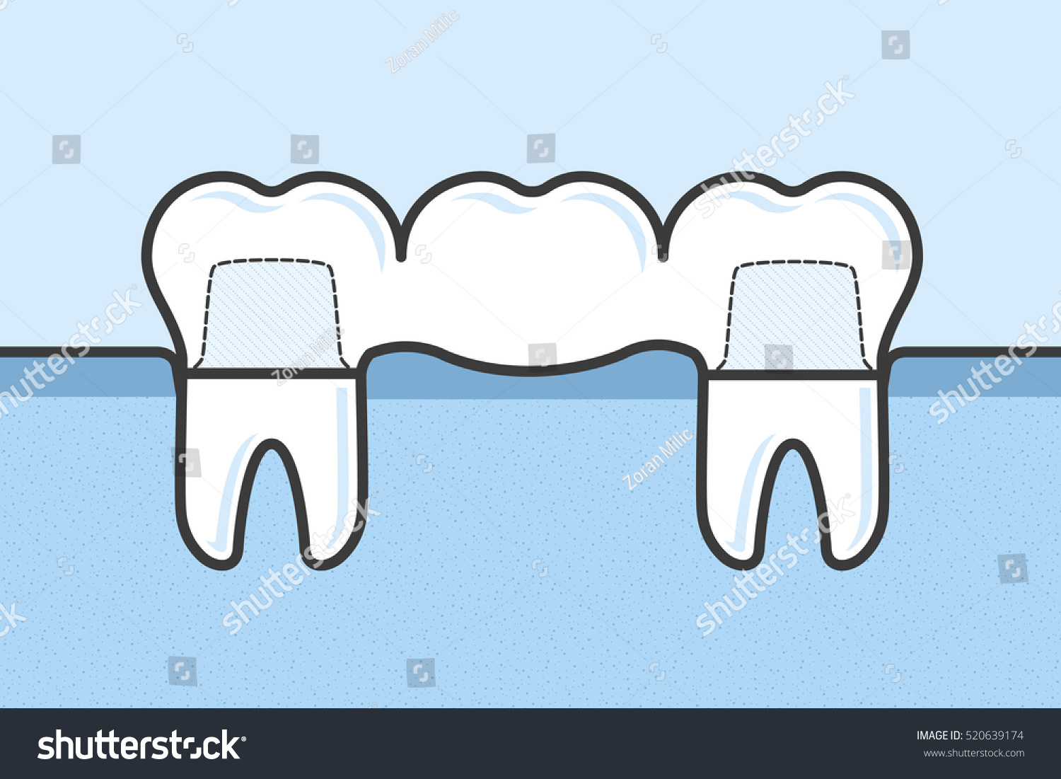 Teeth Dental Bridge Vector Medical Illustration Stock Vector (Royalty ...