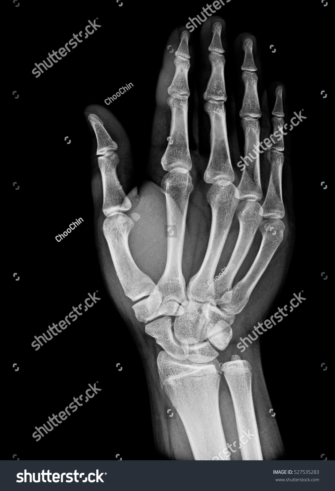 Xray Image Normal Hand Xray Medical Stock Photo 527535283 | Shutterstock