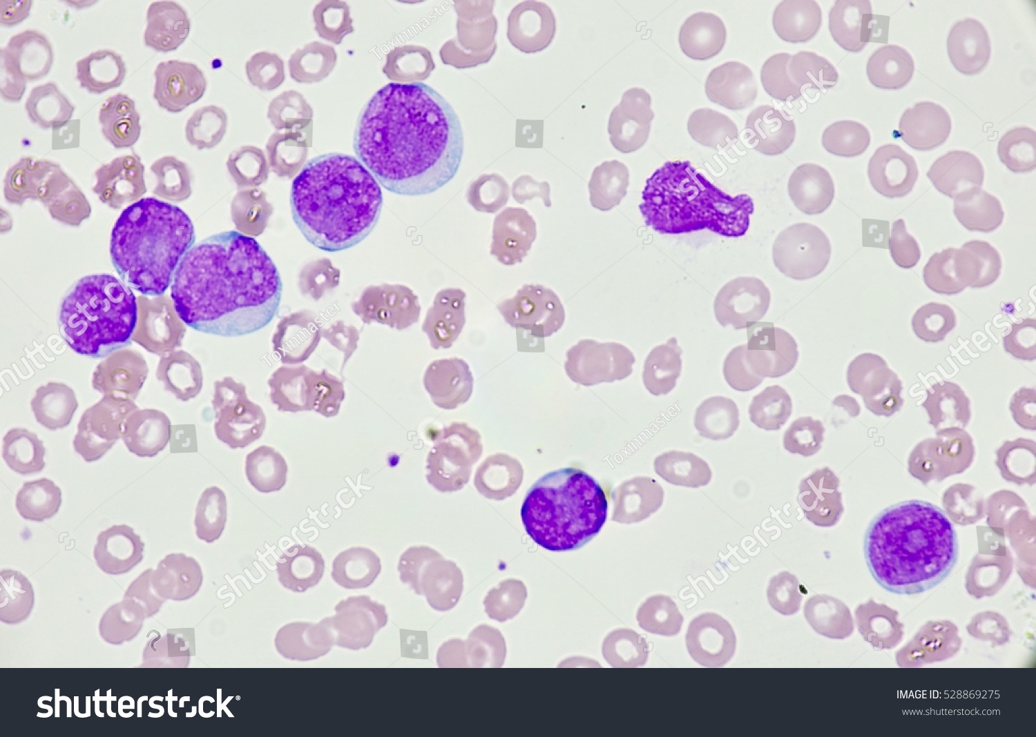 Leukemia Cell Blast Cell Stock Photo 528869275 | Shutterstock