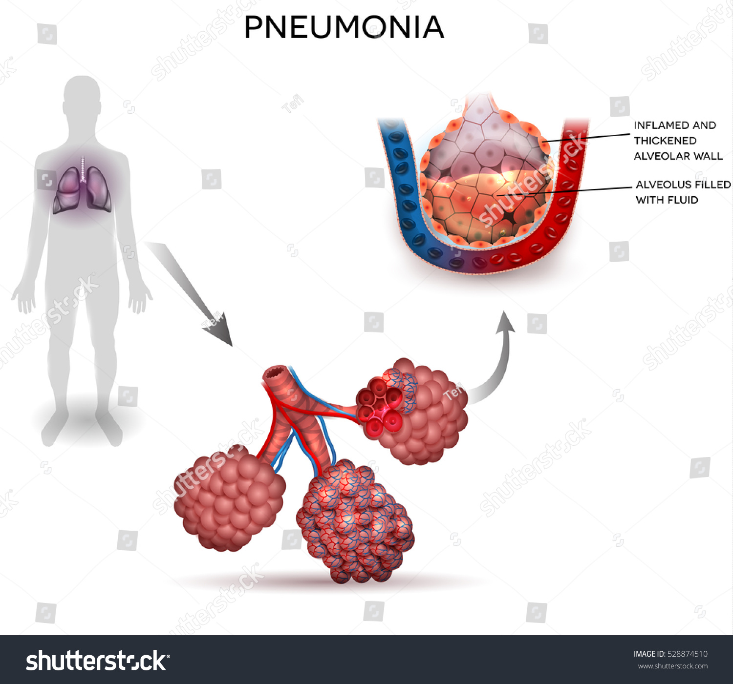 Pneumonia Illustration Human Silhouette Lungs Close Stock Vector ...