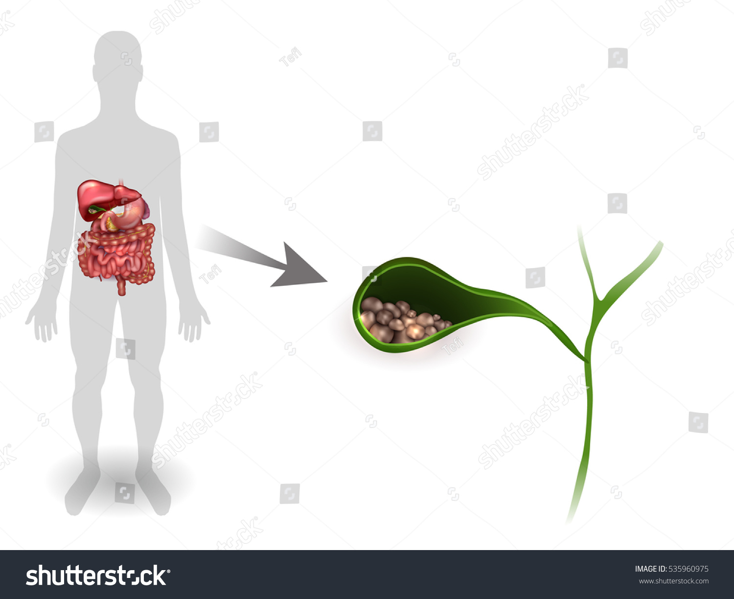 Gallstones Gallbladder Anatomy Bright Detailed Illustration Stock