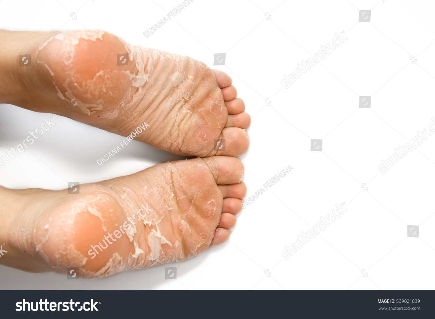 Cracked Skin On Heels Dry Skin Stock Photo 539021839 | Shutterstock