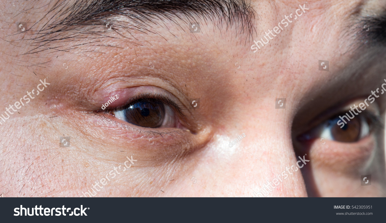 Sore Red Eye Chalazion Blepharitis Inflammation Foto Stok 542305951 ...