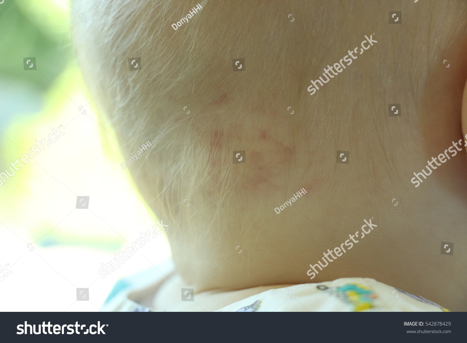 Picture Skin Red Flat Papular Rash Stock Photo 542878429 | Shutterstock