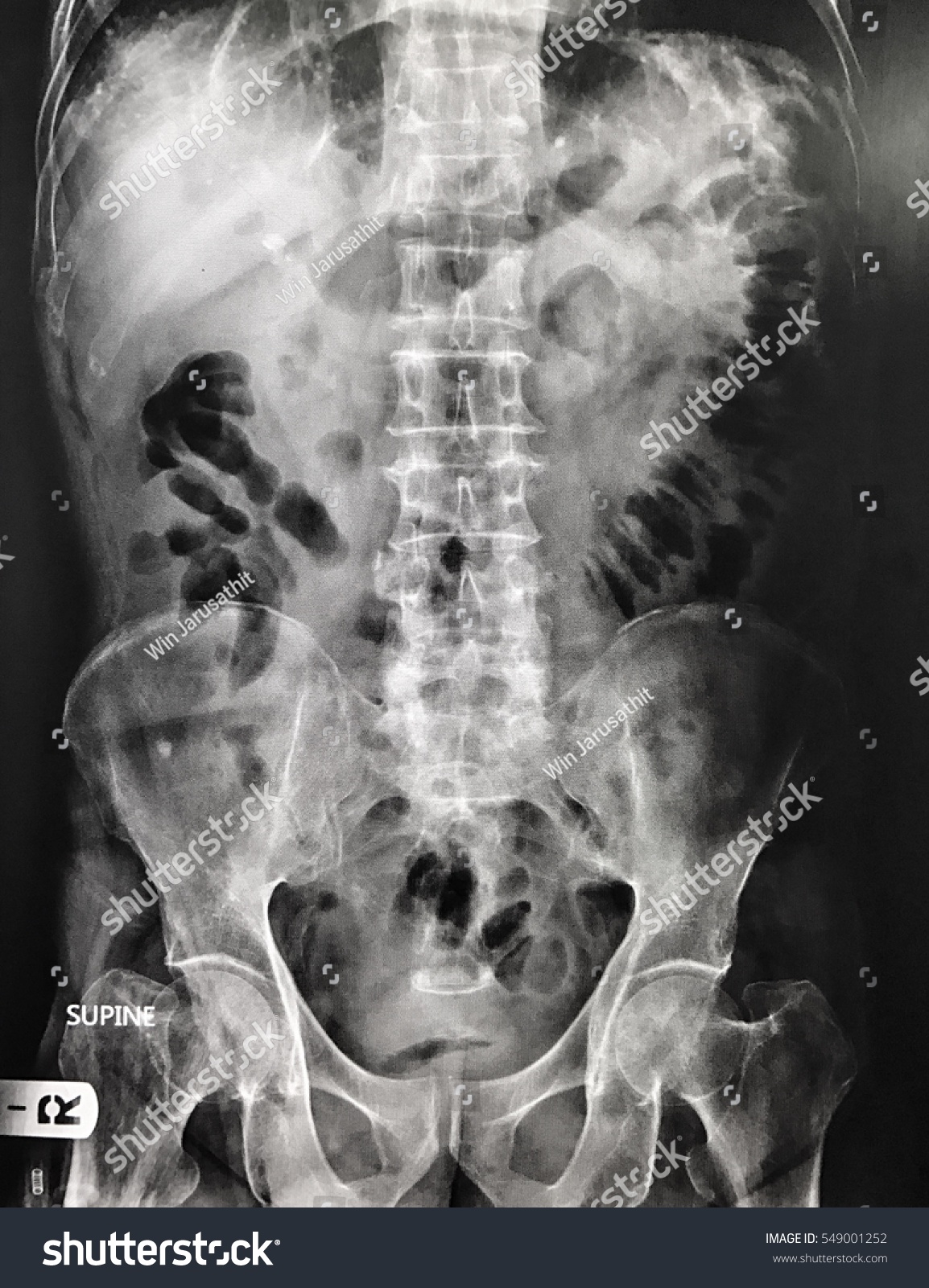 Xray Abdomen Film Ap Supine Stock Photo 549001252 | Shutterstock