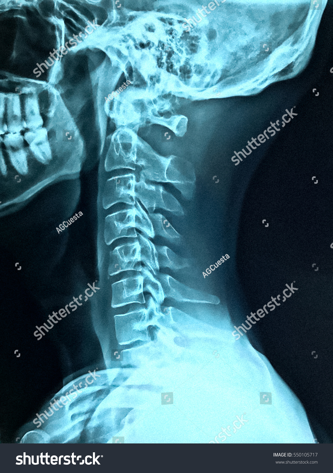 Xray Neck Cervical Sprain Rectification Lumbar Stock Photo 550105717 ...