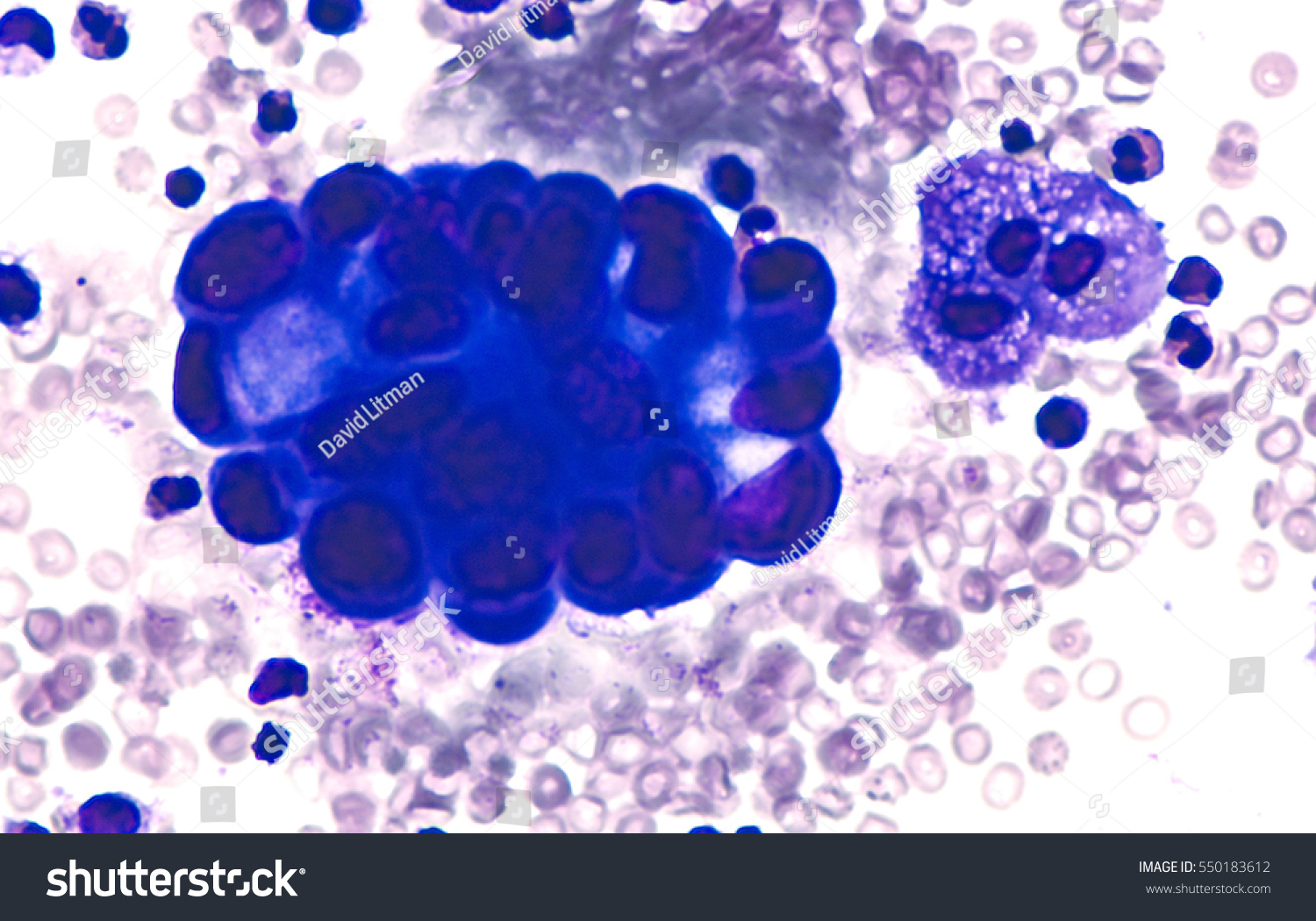 malignant-effusion-pleural-fluid-cytology-lung-nh-c-s-n550183612