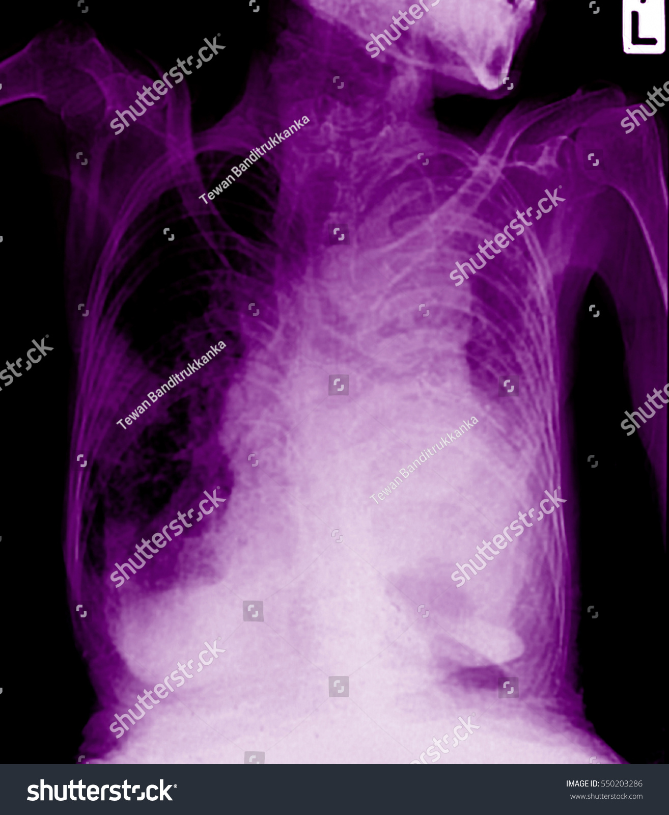 Lung Cancer Pleural Effusion Stock Photo 550203286 Shutterstock