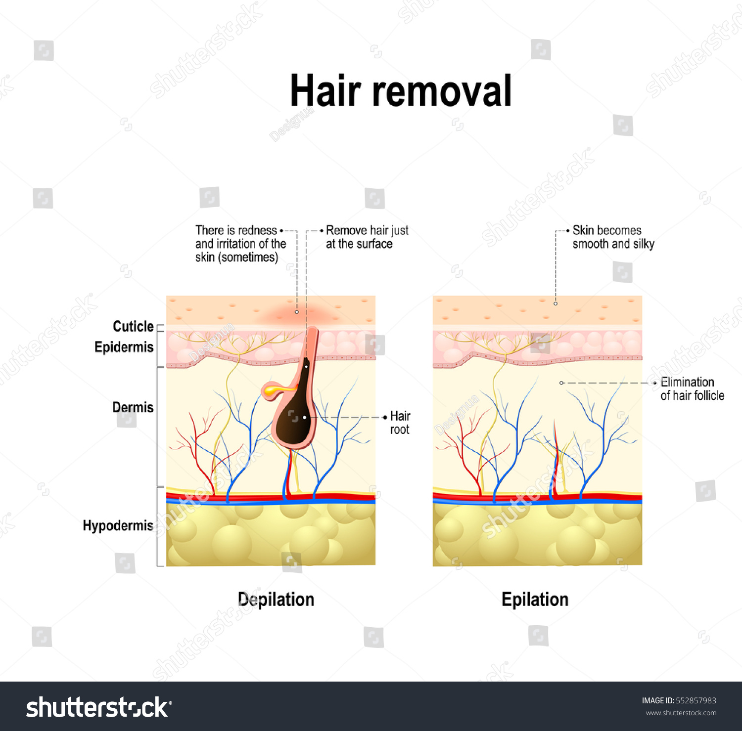 Epilation Depilation Difference Hair Removal Human Stock Vector ...