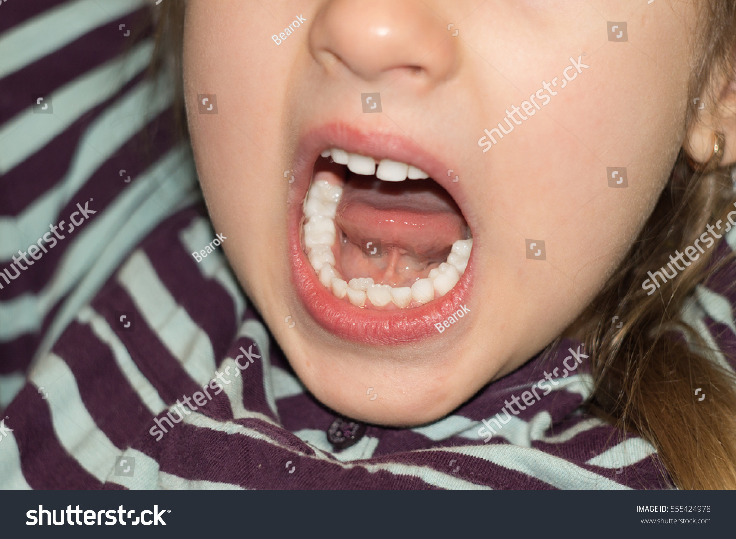 Акульи зубы у девочки фото