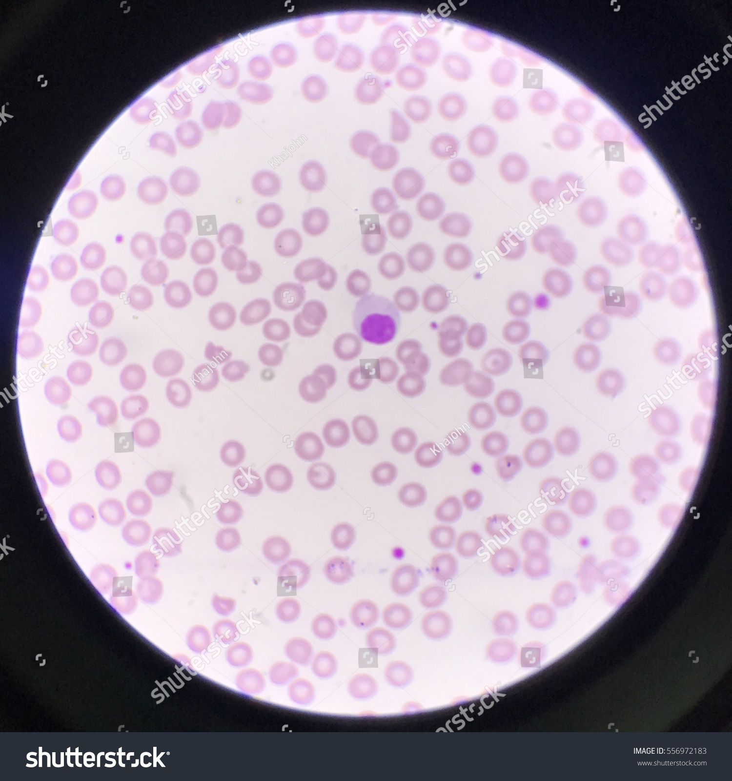 Blood Smear Lymphocytopenia Stock Photo 556972183 | Shutterstock