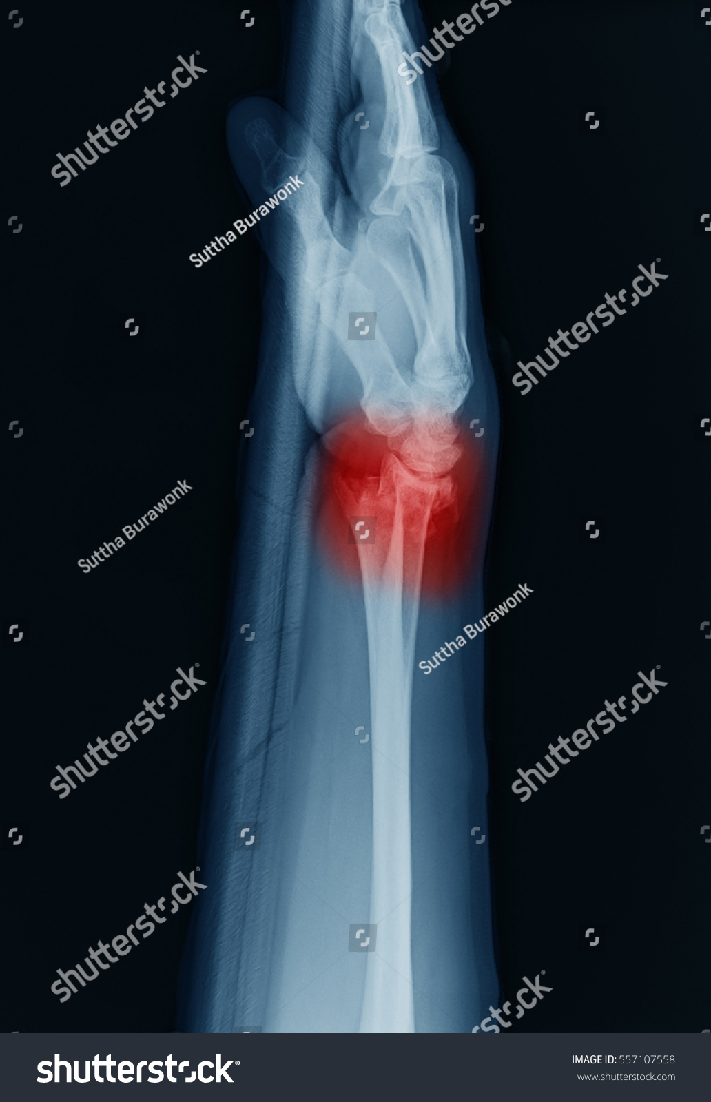 Computed Radiography Image Distal Forearm Fracture Stock Photo ...