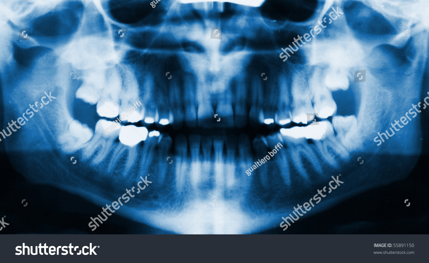 Detail Panoramic Facial Xray Image Stock Photo 55891150 | Shutterstock