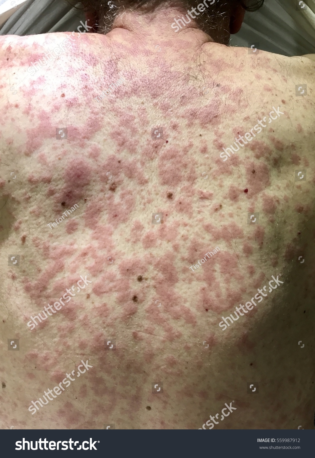 maculopapular rash hiv