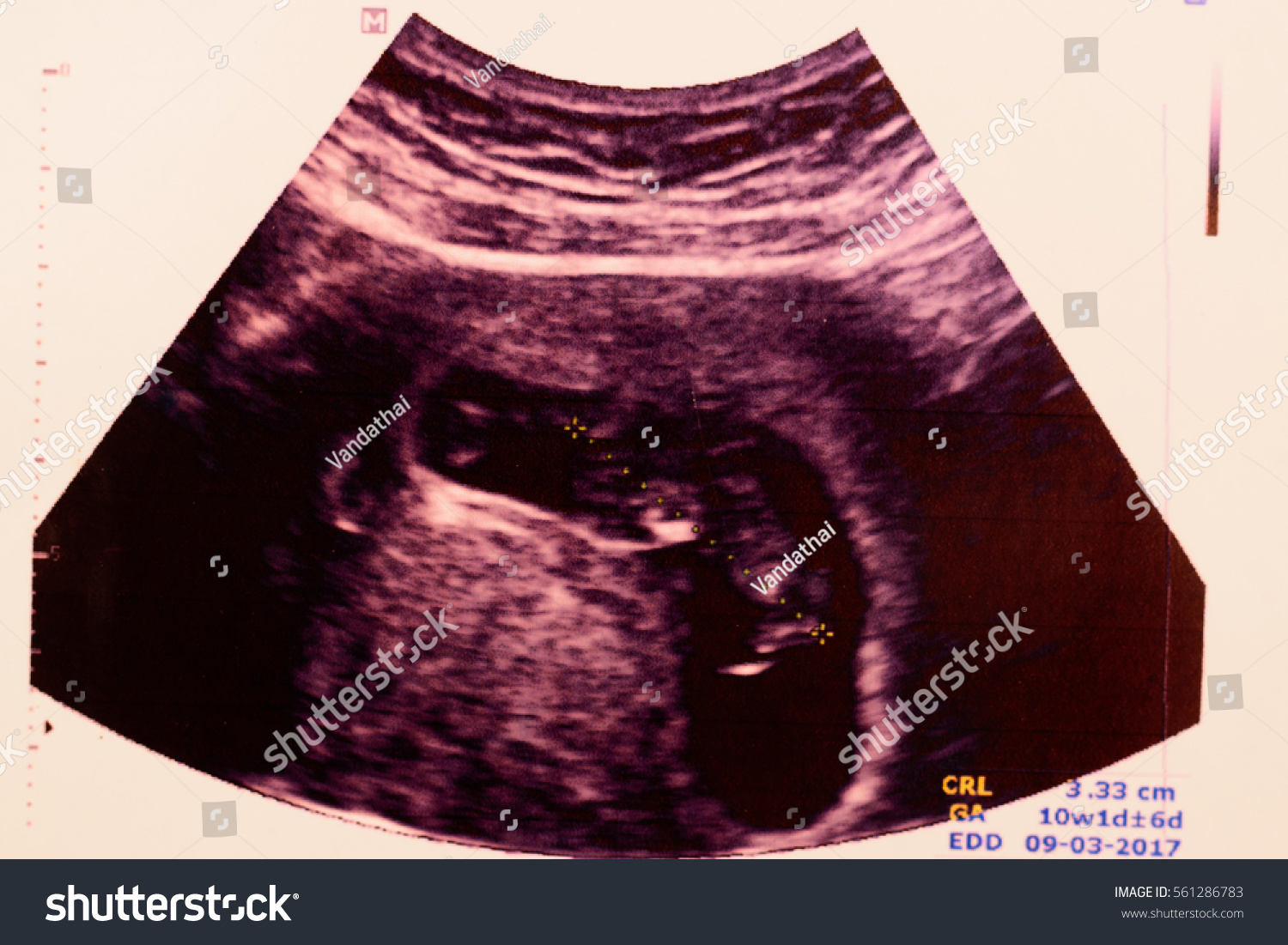 fetus 10 weeks pictures ultrasound