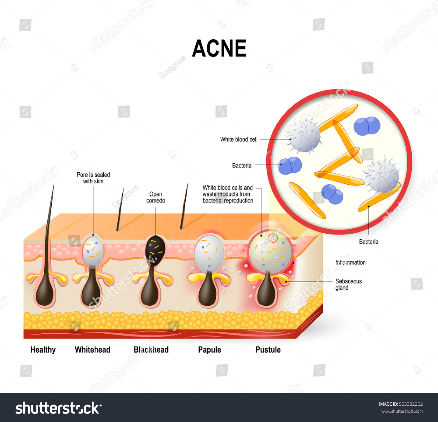 Acne Vulgaris Pimple Sebum Dead Skin Stock Illustration 563322262 ...