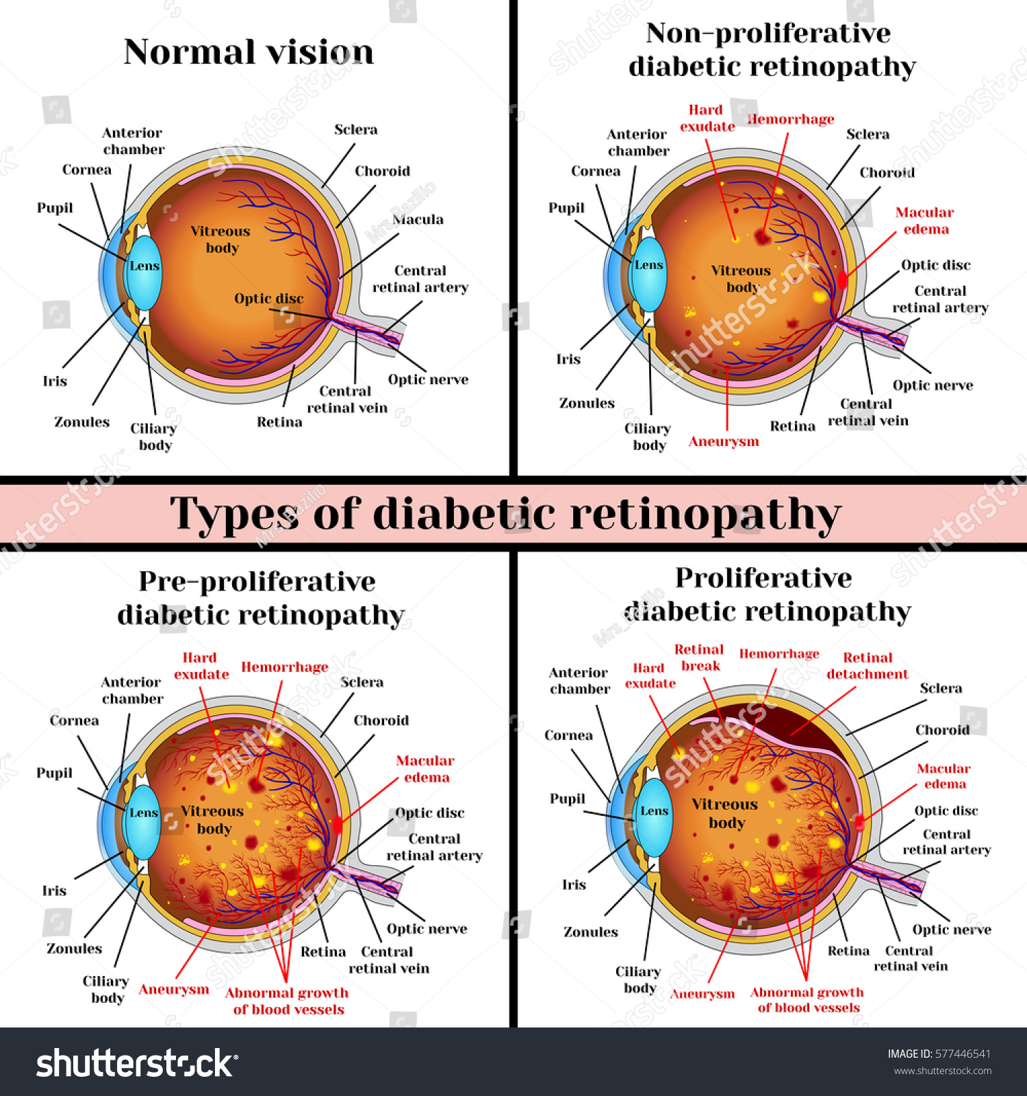 Vektor Stok Types Diabetic Retinopathy Nonproliferative