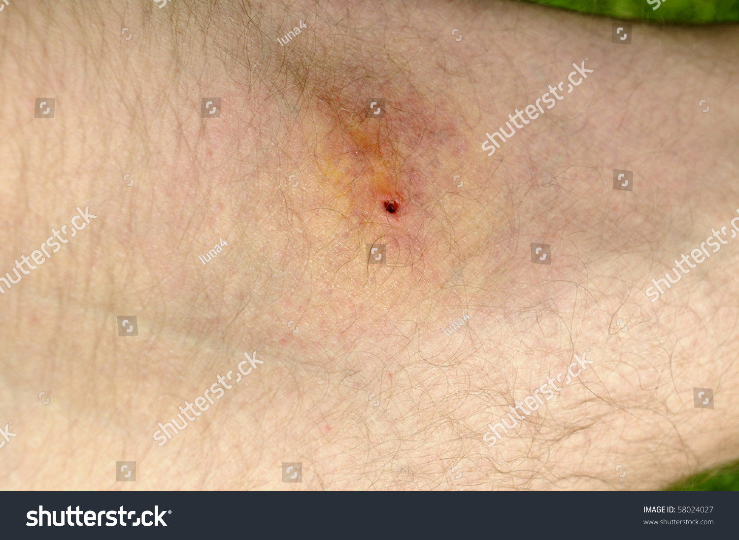Infected Tick Bite On Thigh Stock Photo 58024027 Shutterstock