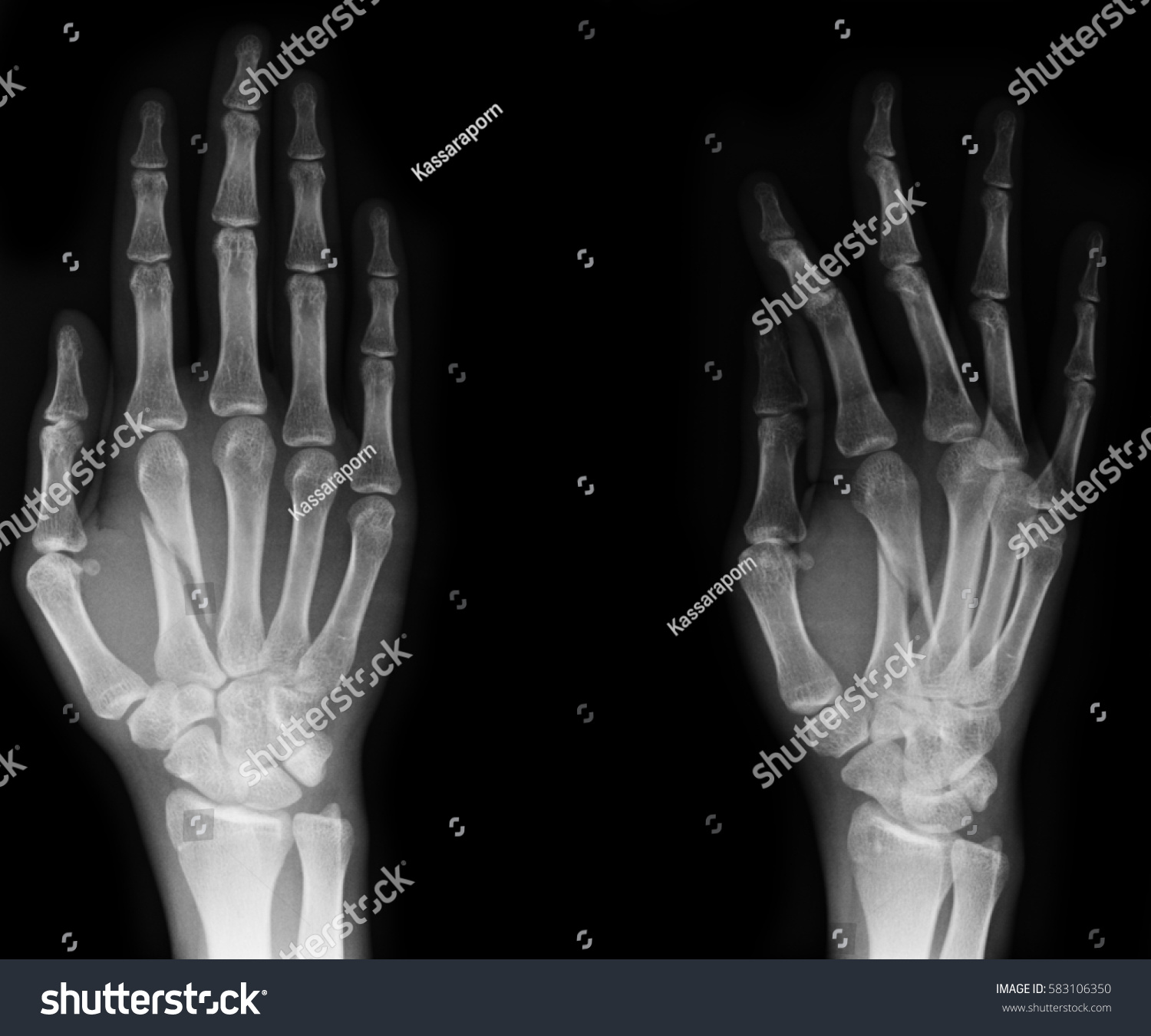 Hand Xrays Image Show Fracture Bone Stock Photo 583106350 | Shutterstock