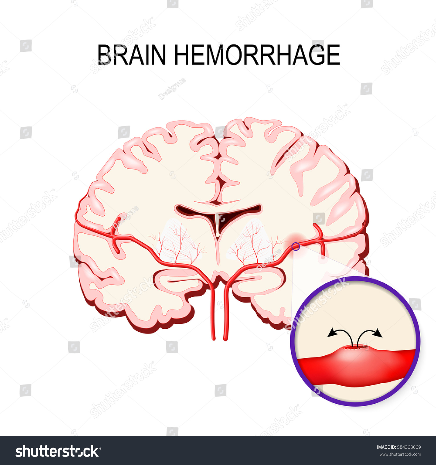 Cerebral Hemorrhage Stroke Bleeding Inside Human Stock Vector (Royalty ...