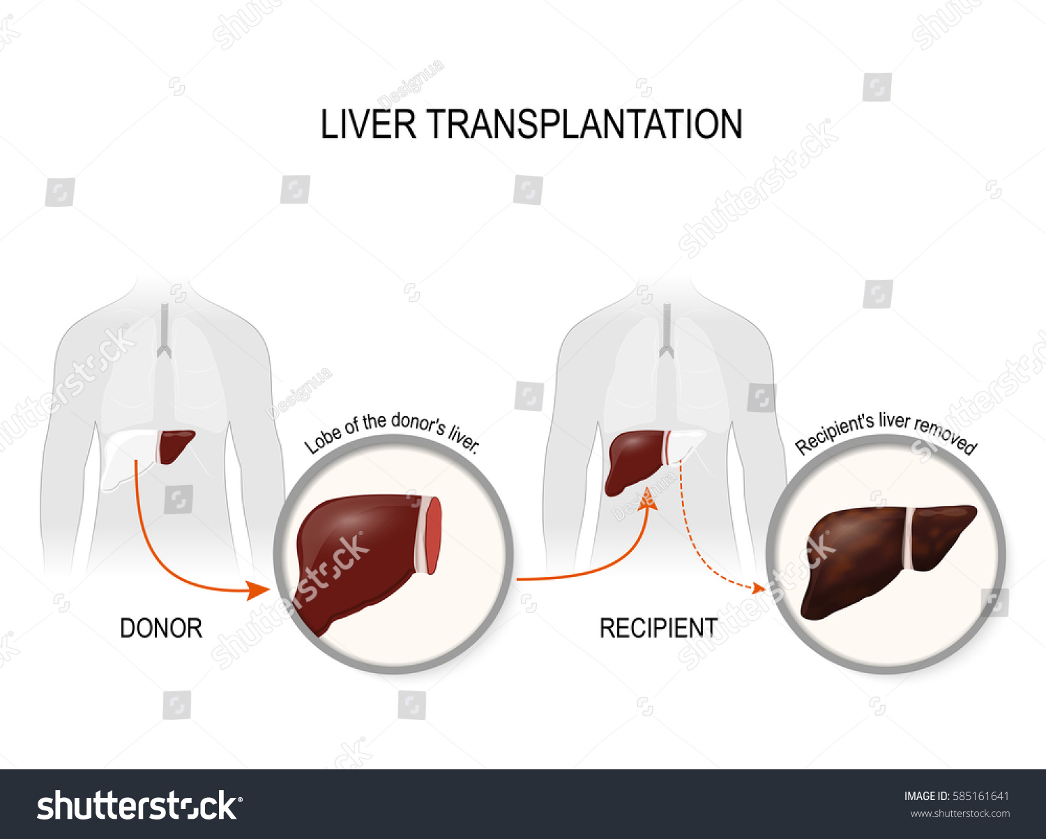 Реципиент трансплантация. Трансплантация печени. Донорство части печени. Имплантация донорской печени.