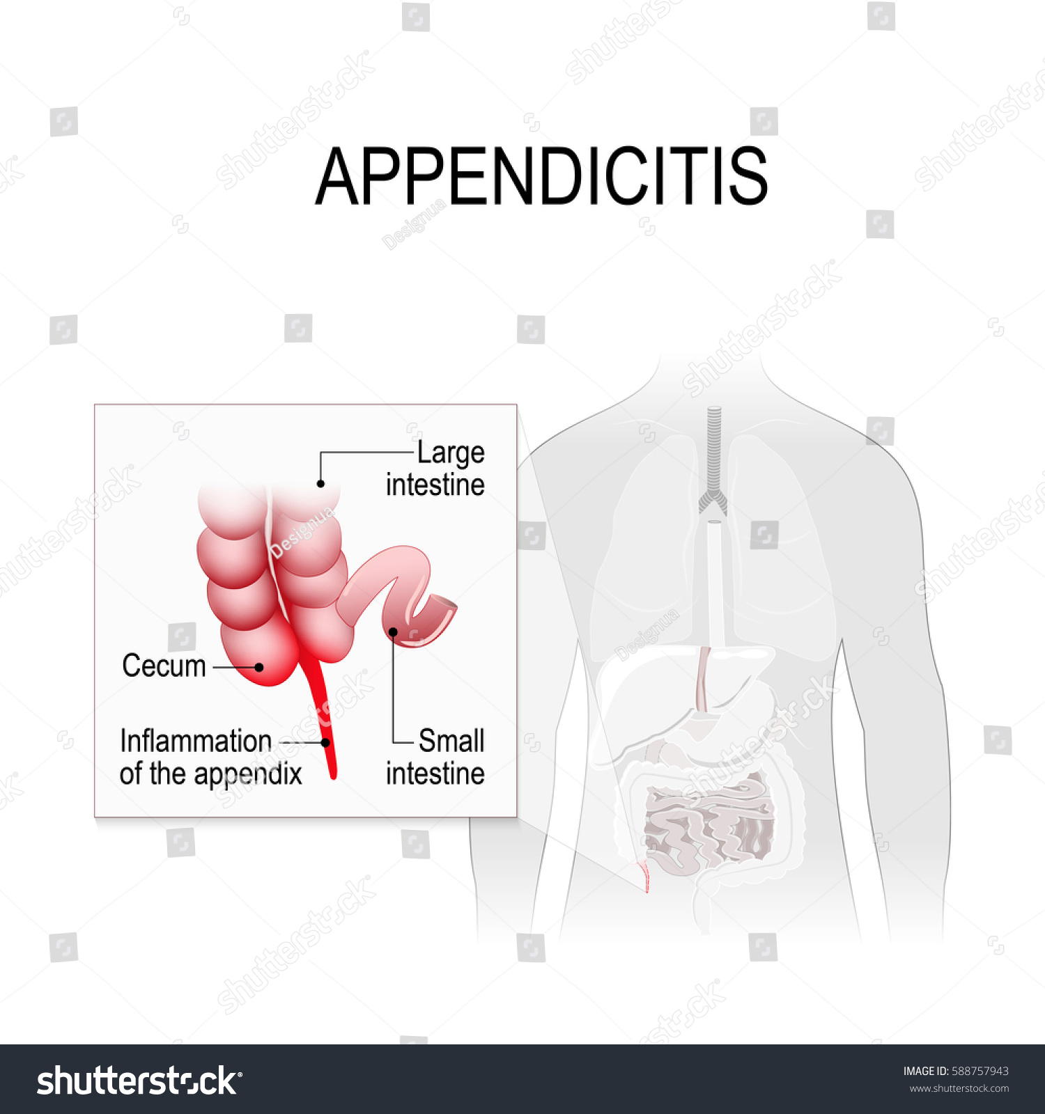 Appendicitis Inflammation Appendix Location Appendix Digestive Stock ...