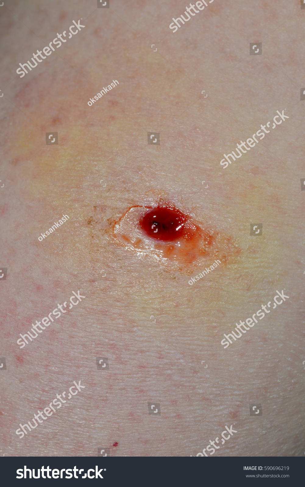 Fresh Punch Biopsy Wounds Testing Melanoma Stock Photo 590696219