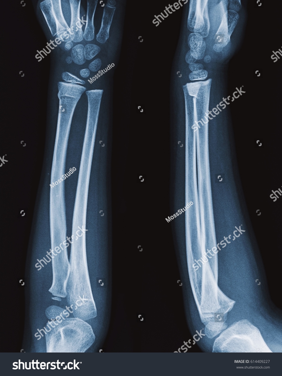 111 Incomplete Fracture Images, Stock Photos & Vectors | Shutterstock