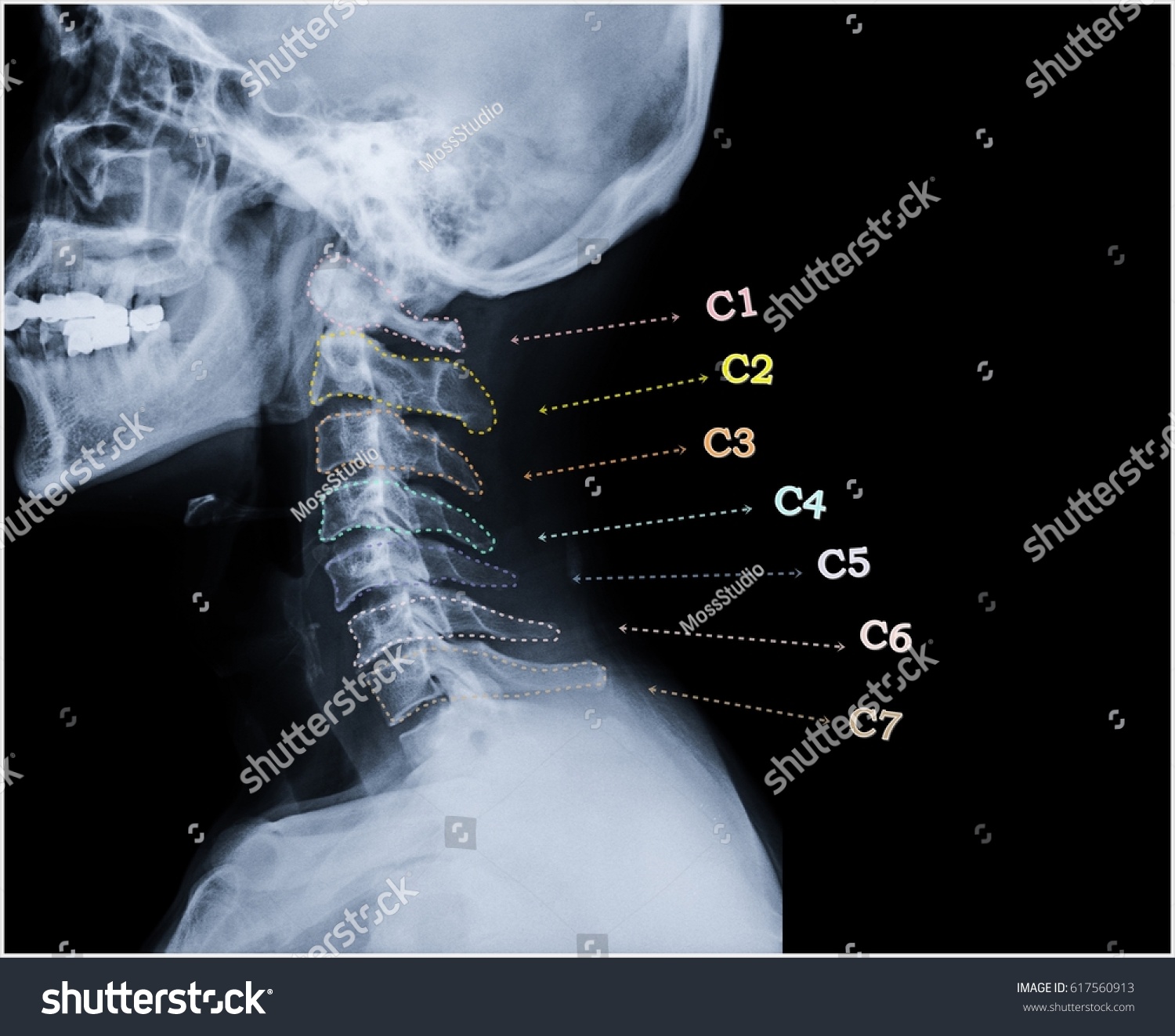 cervical spine x ray down