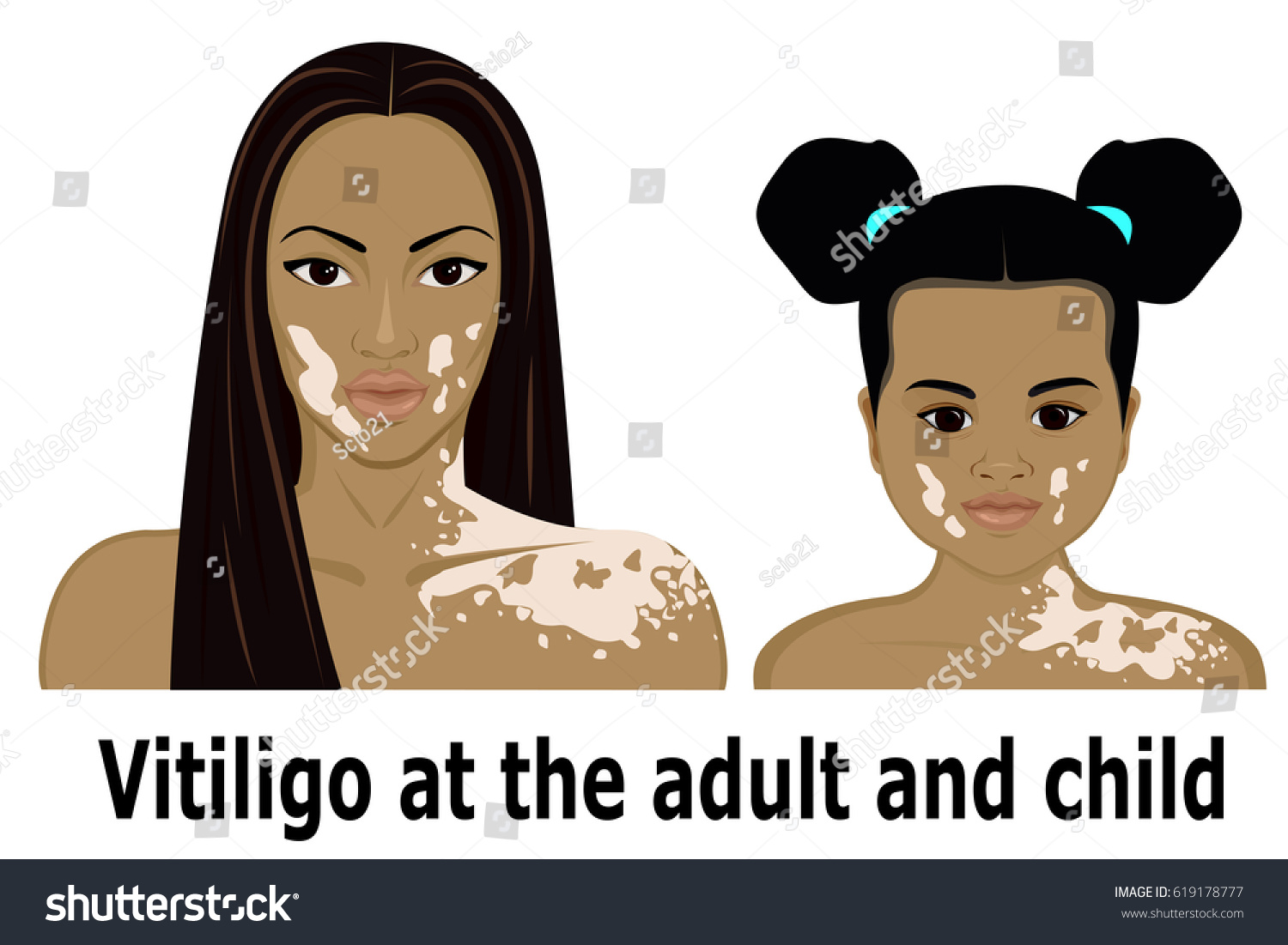 vitiligo around mouth images clipart