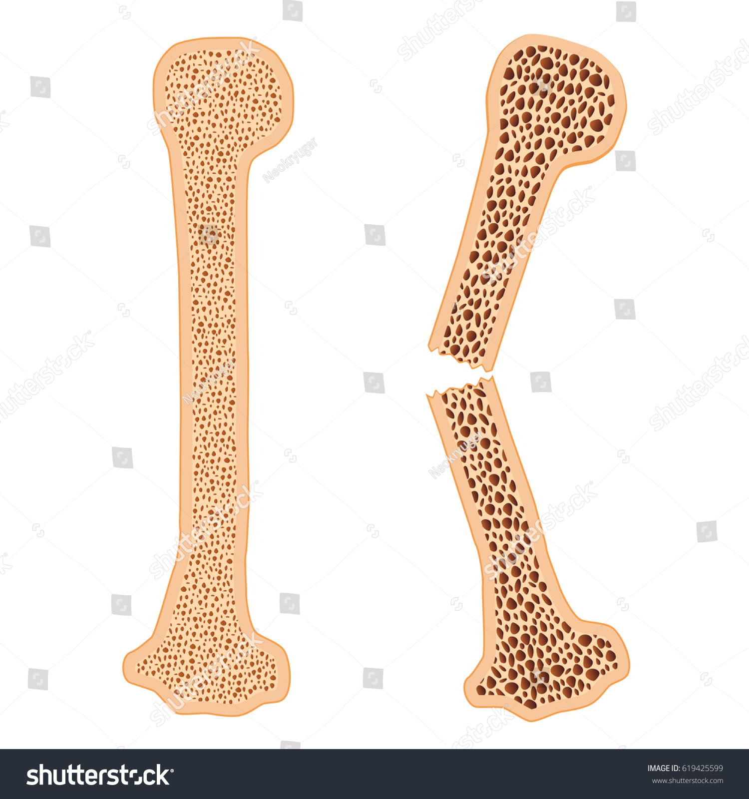 Healthy Bone Broken Bone Osteoporosis On Stock Vector (Royalty Free ...