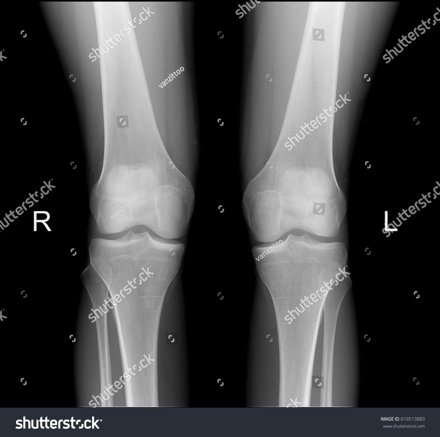 Xray Knee Joints Frontal Projection Normal Stock Photo 619513883 