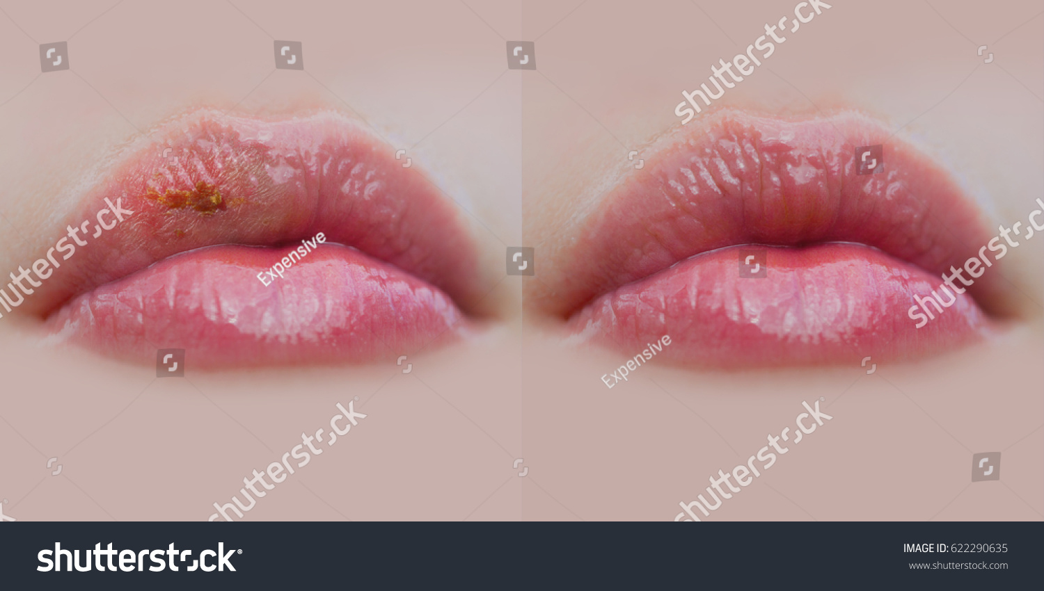 Грибковое заболевание губ