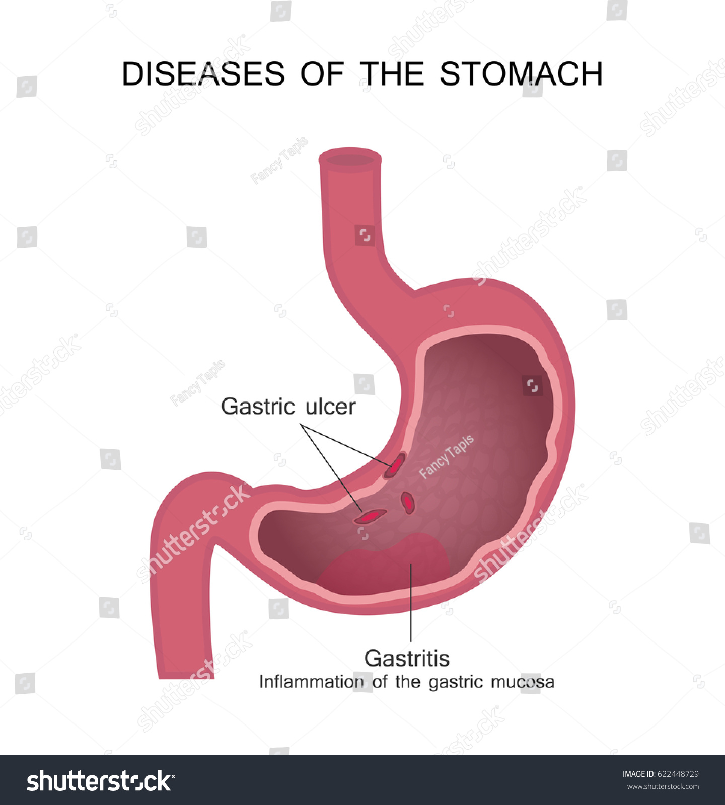 Diseases Stomach Peptic Ulcer Gastritis Vector Stock Vector (Royalty ...