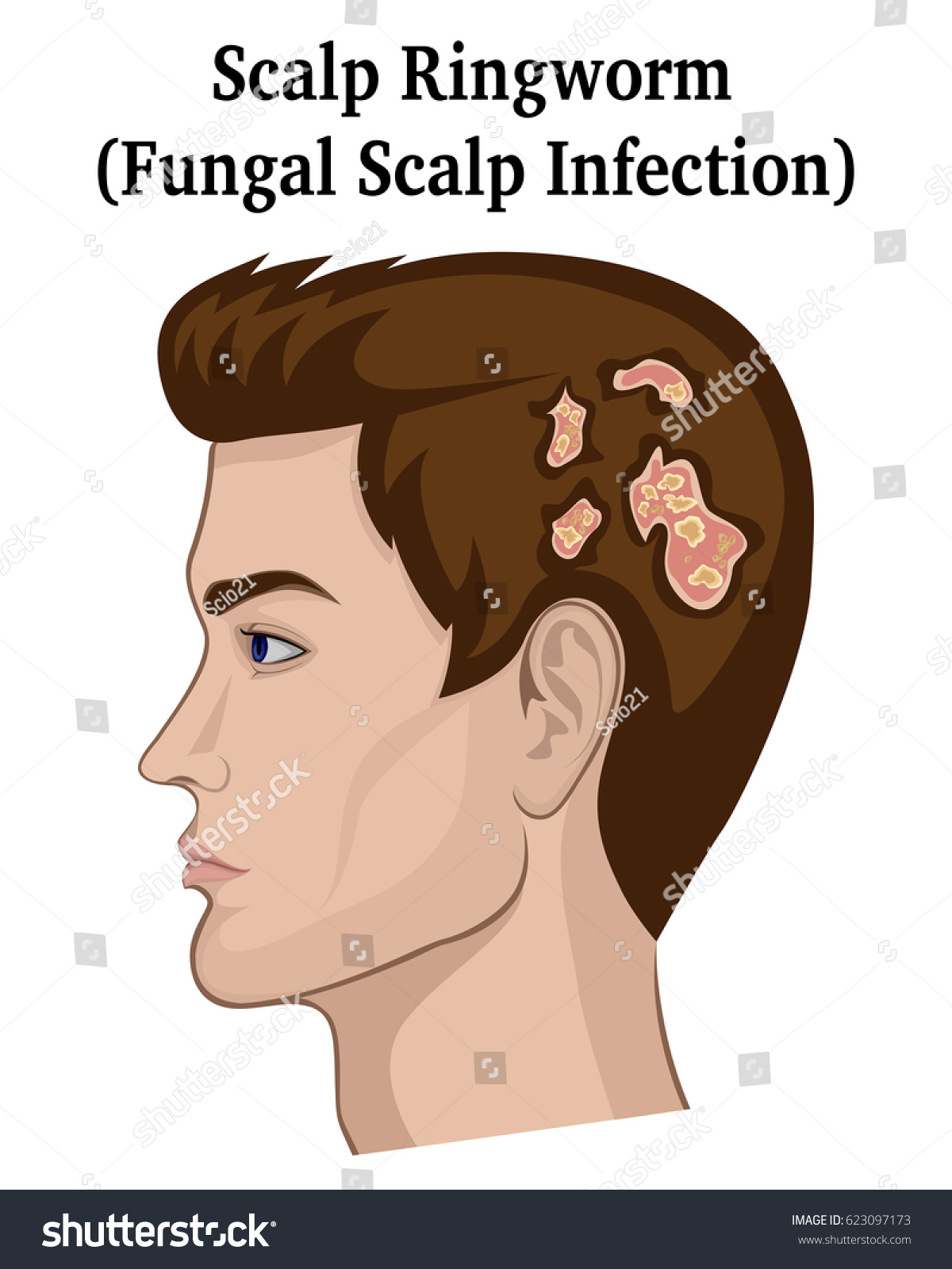 Young Man Symptoms Fungal Infection Scalp Stock Vector Royalty Free 623097173 Shutterstock 5646