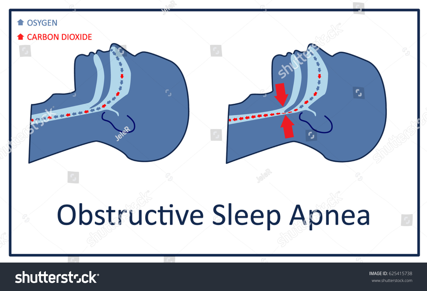 Vector Illustration Obstructive Sleep Apnea Stock Vector Royalty Free 625415738 Shutterstock