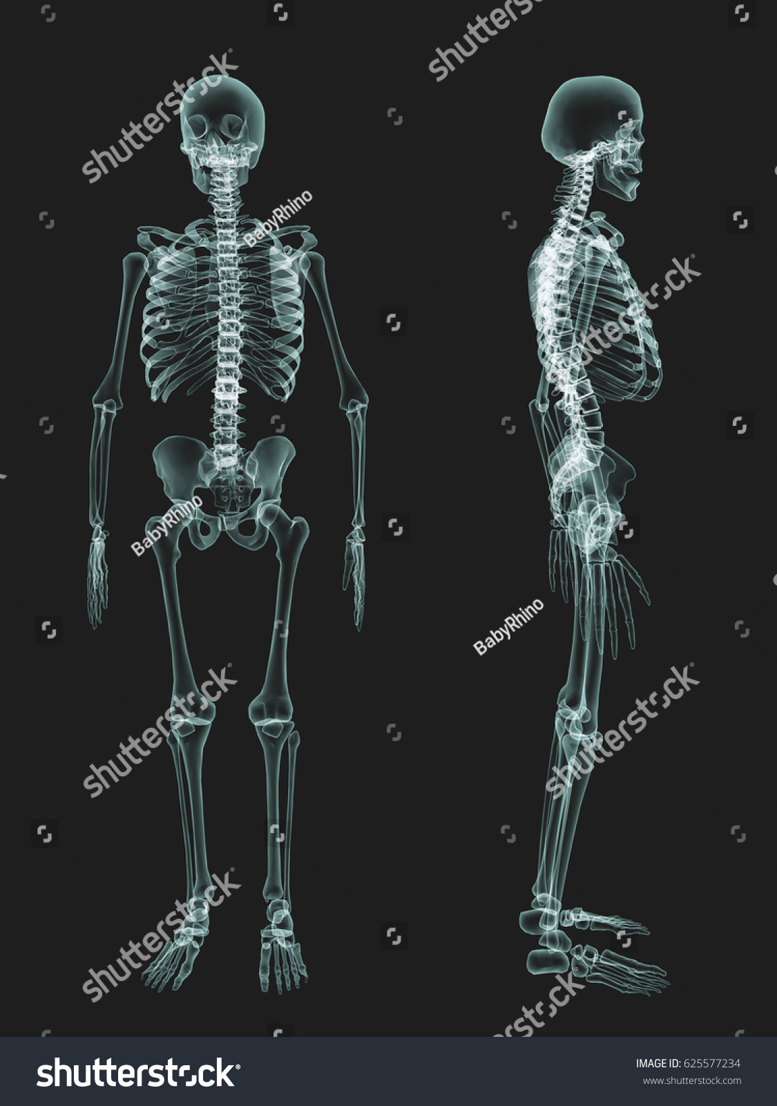 multiple-myeloma-full-skeletal-survey-image-radiopaedia