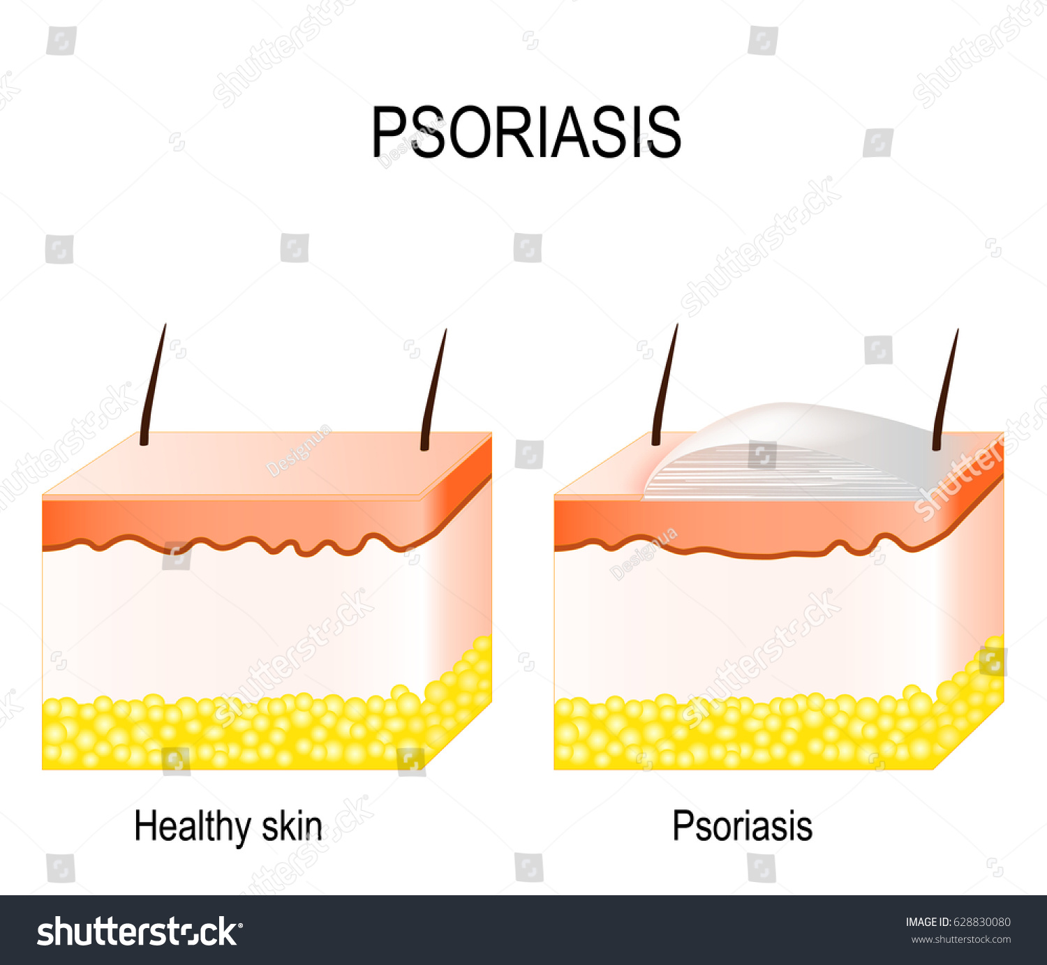 Normal Skin Psoriasis Plaque Psoriasis Stock Vector (Royalty Free ...