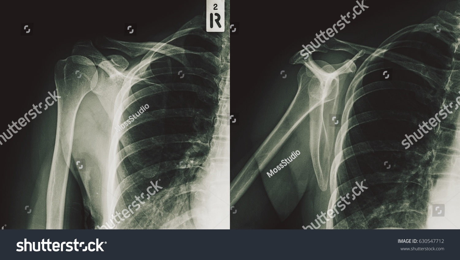 Film Xray Shoulder Ap Transcapular View Stock Photo 630547712 Shutterstock