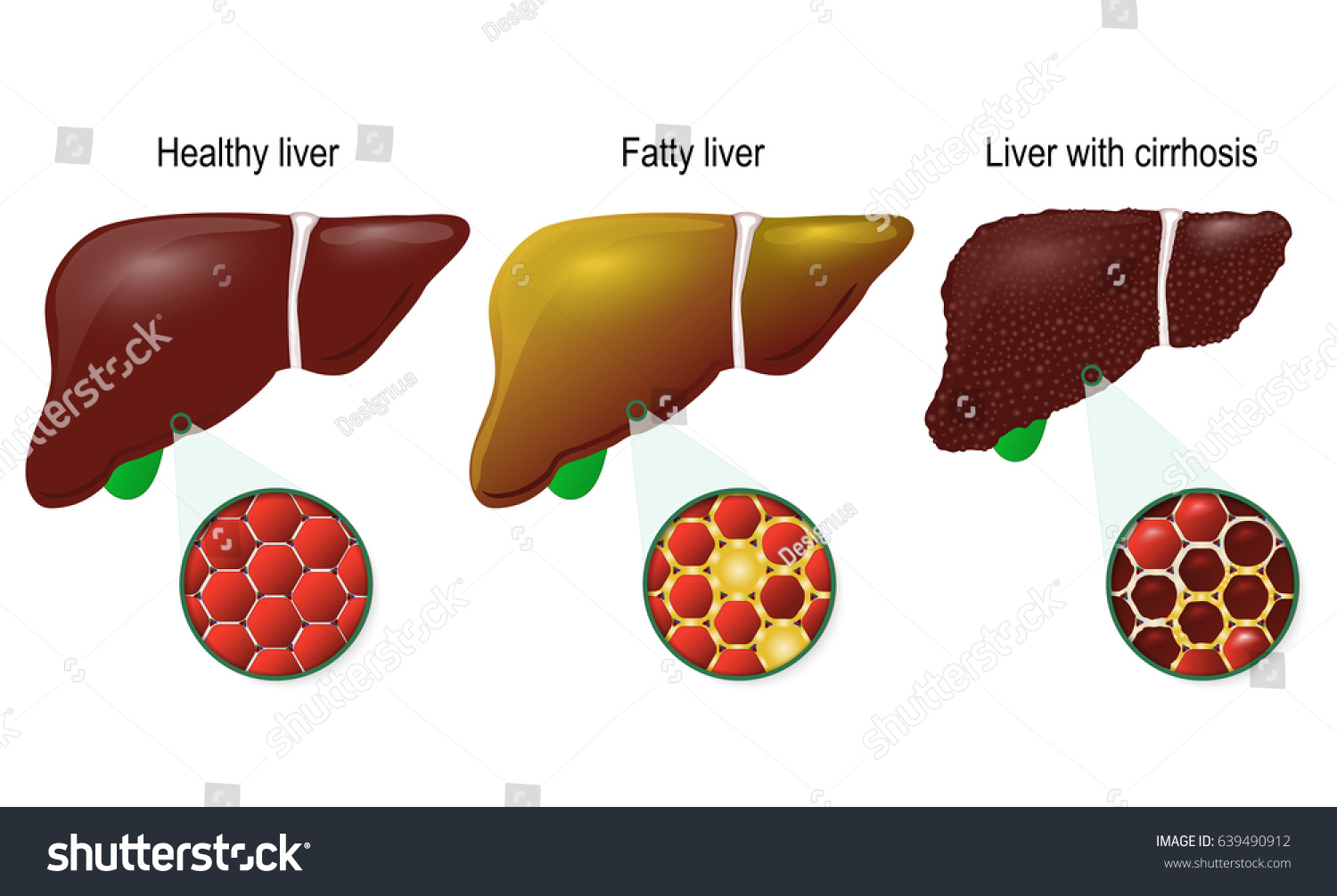 liver-disease-healthy-fatty-cirrhosis-liver-stock-vector-royalty-free